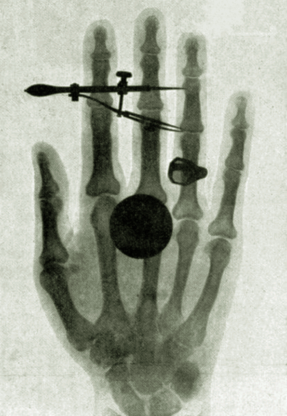 wilhelm-roentgens-x-ray-photograph-of-his-wifes-hand1